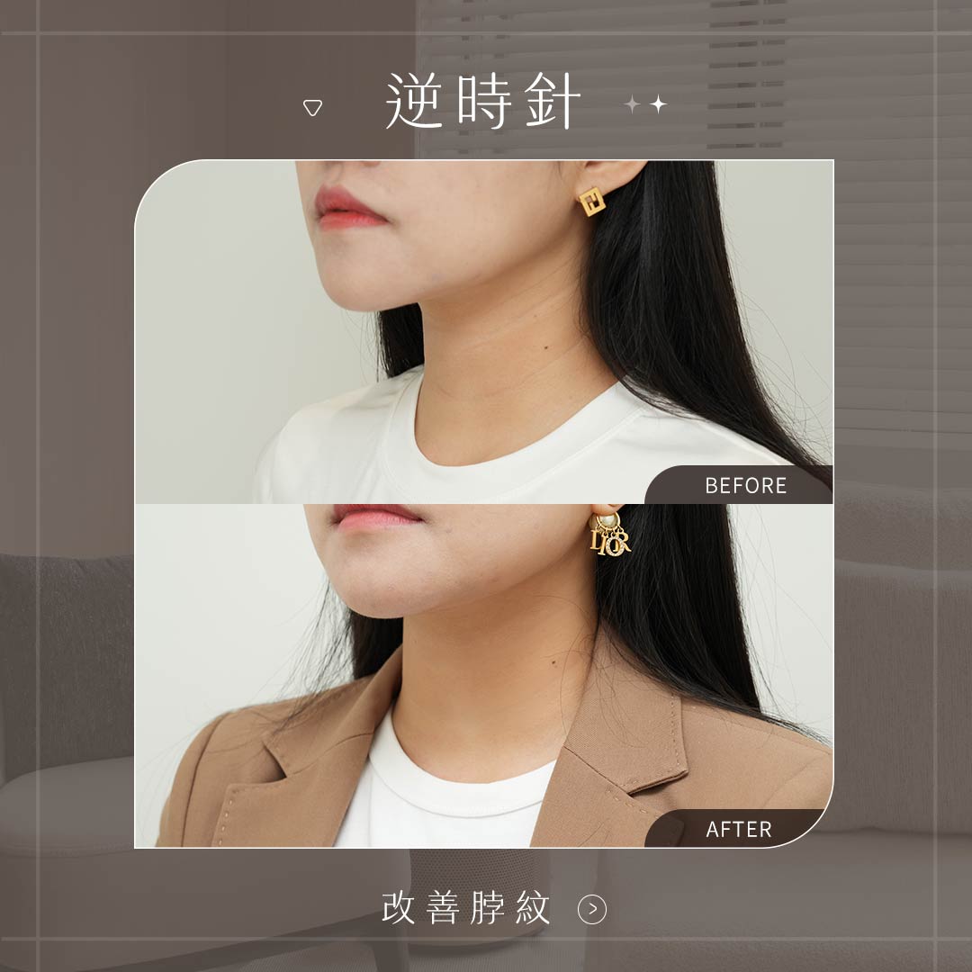 美力時尚診所逆時針案例：改善脖紋