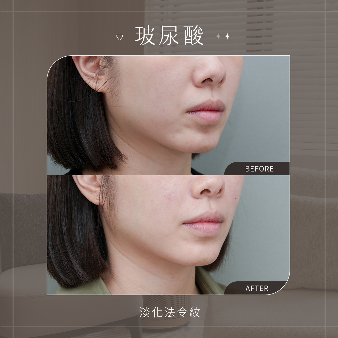 美力時尚診所中分子玻尿酸案例：改善法令紋