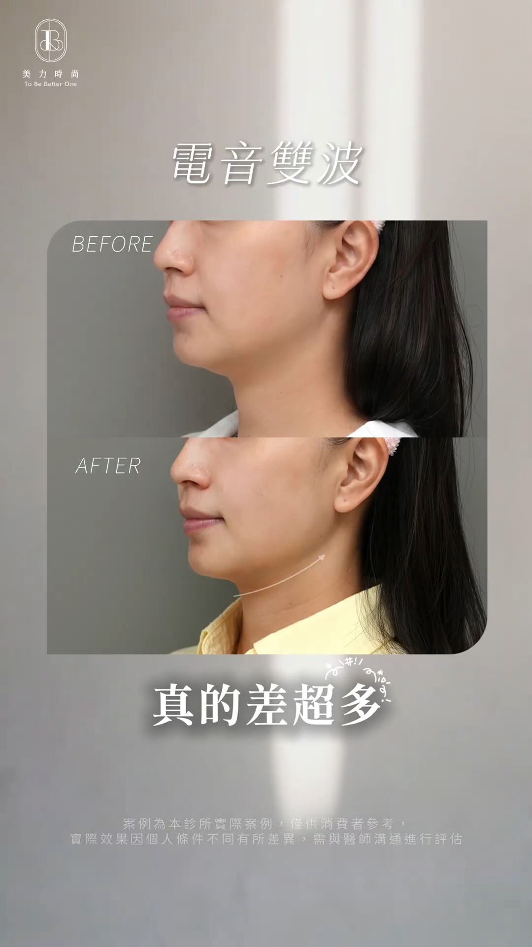 美力時尚診所十蓓電波＋海芙音波案例：術後輪廓線變化_側面