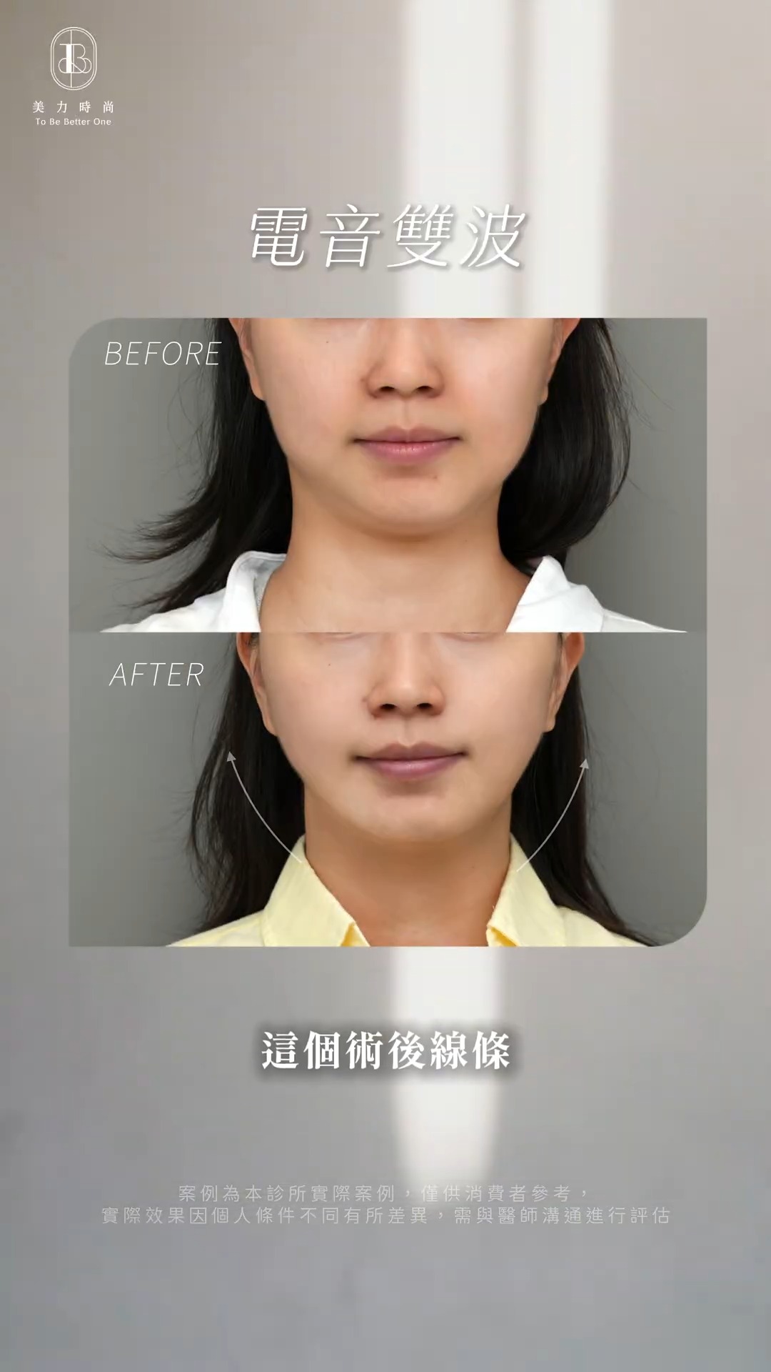 美力時尚診所十蓓電波＋海芙音波案例：輪廓線變化_正面