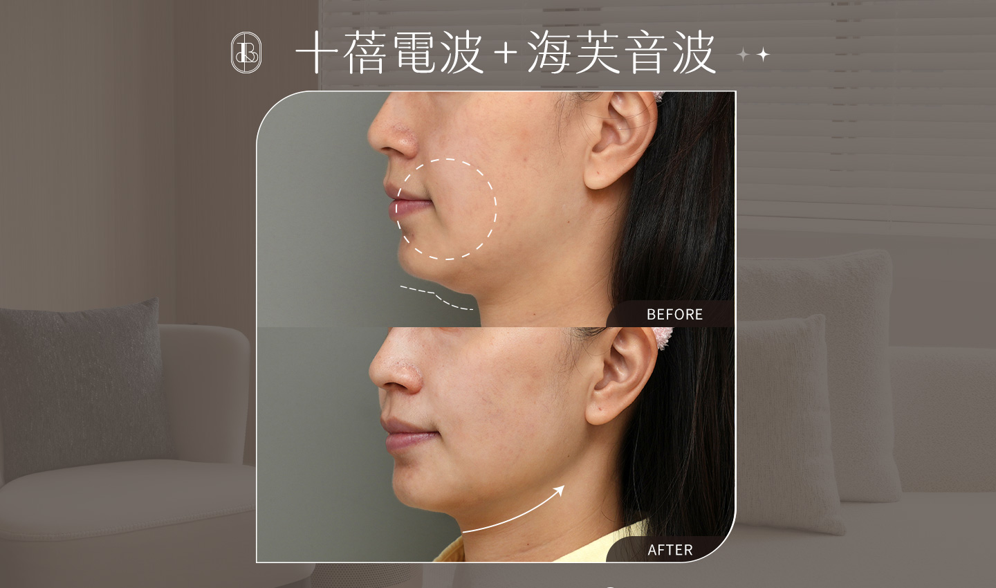 美力時尚診所十蓓電波＋海芙音波案例：雙下巴改善、輪廓線變清晰