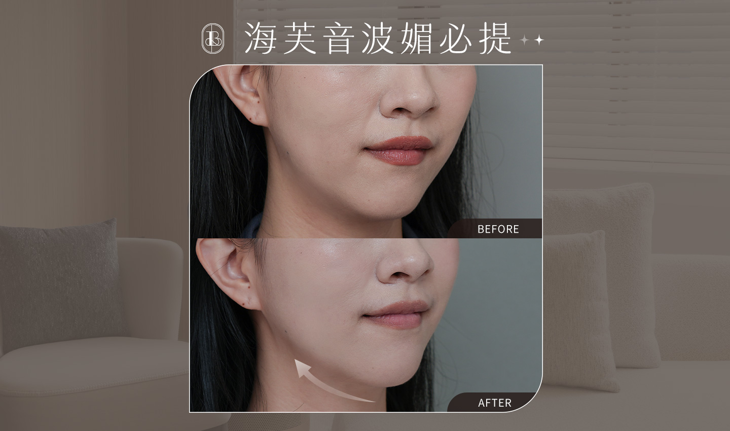 美力時尚診所海芙音波媚必提案例：改善雙下巴、下顎線_ＭＰＴ800