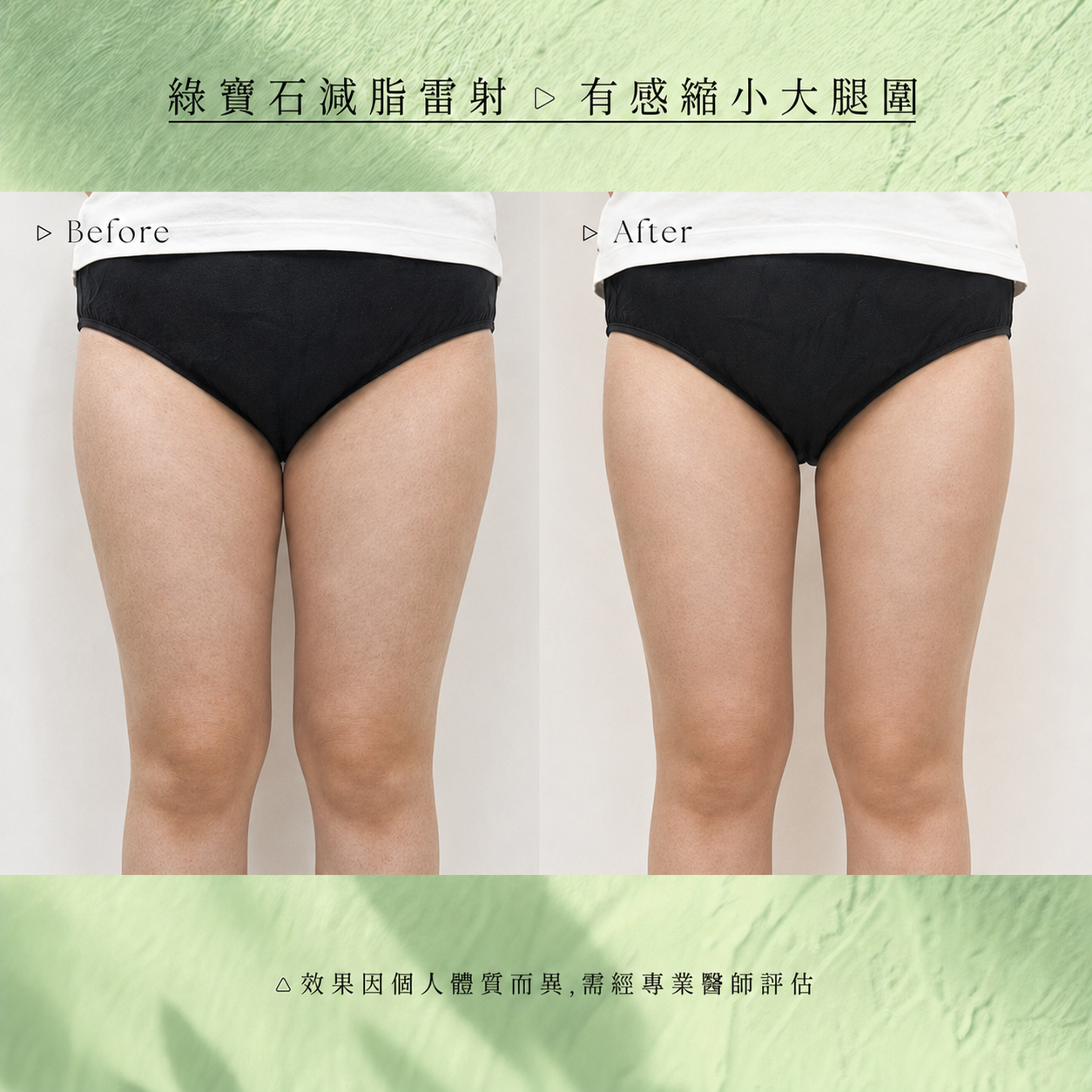 美力時尚診所綠寶石減脂雷射案例：改善大腿腿圍
