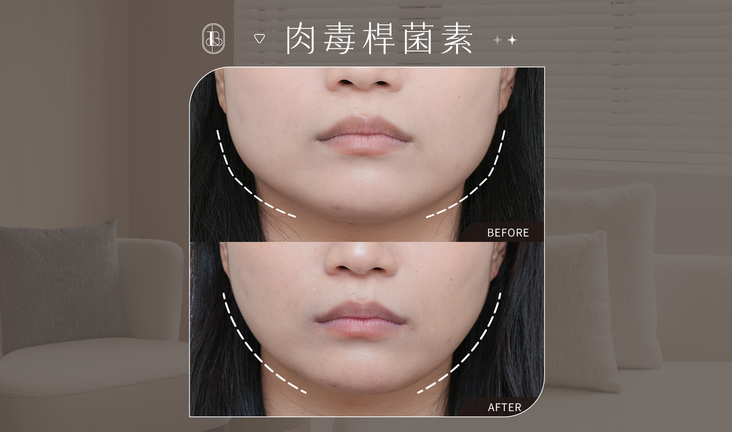 美力時尚診所肉毒小臉案例：咀嚼肌BA