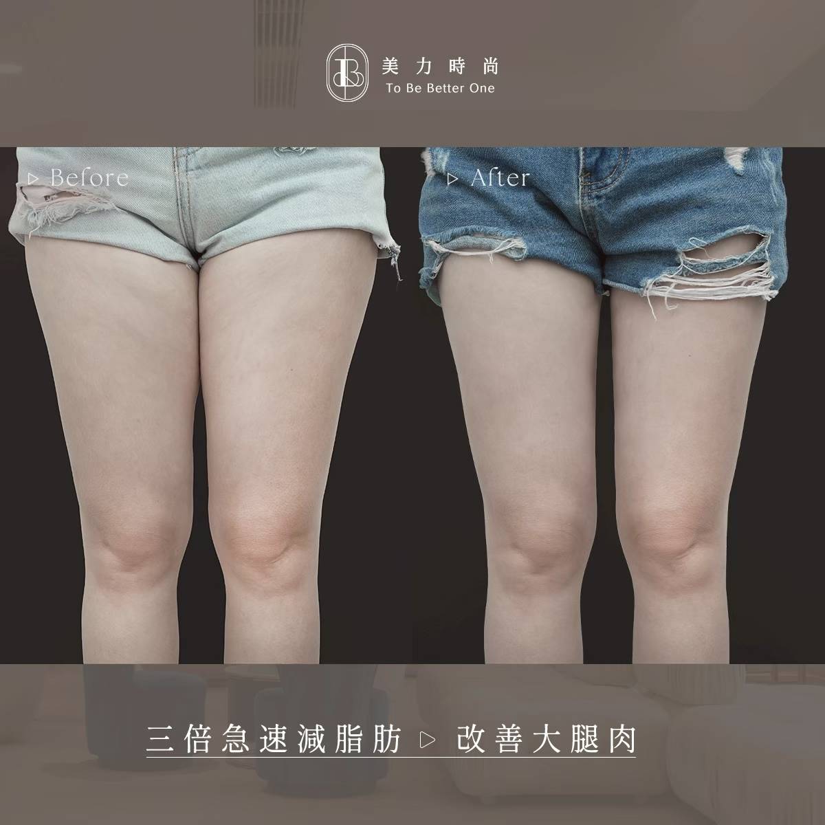 美力時尚診所阿爾發冷凍減脂案例：改善大腿腿圍