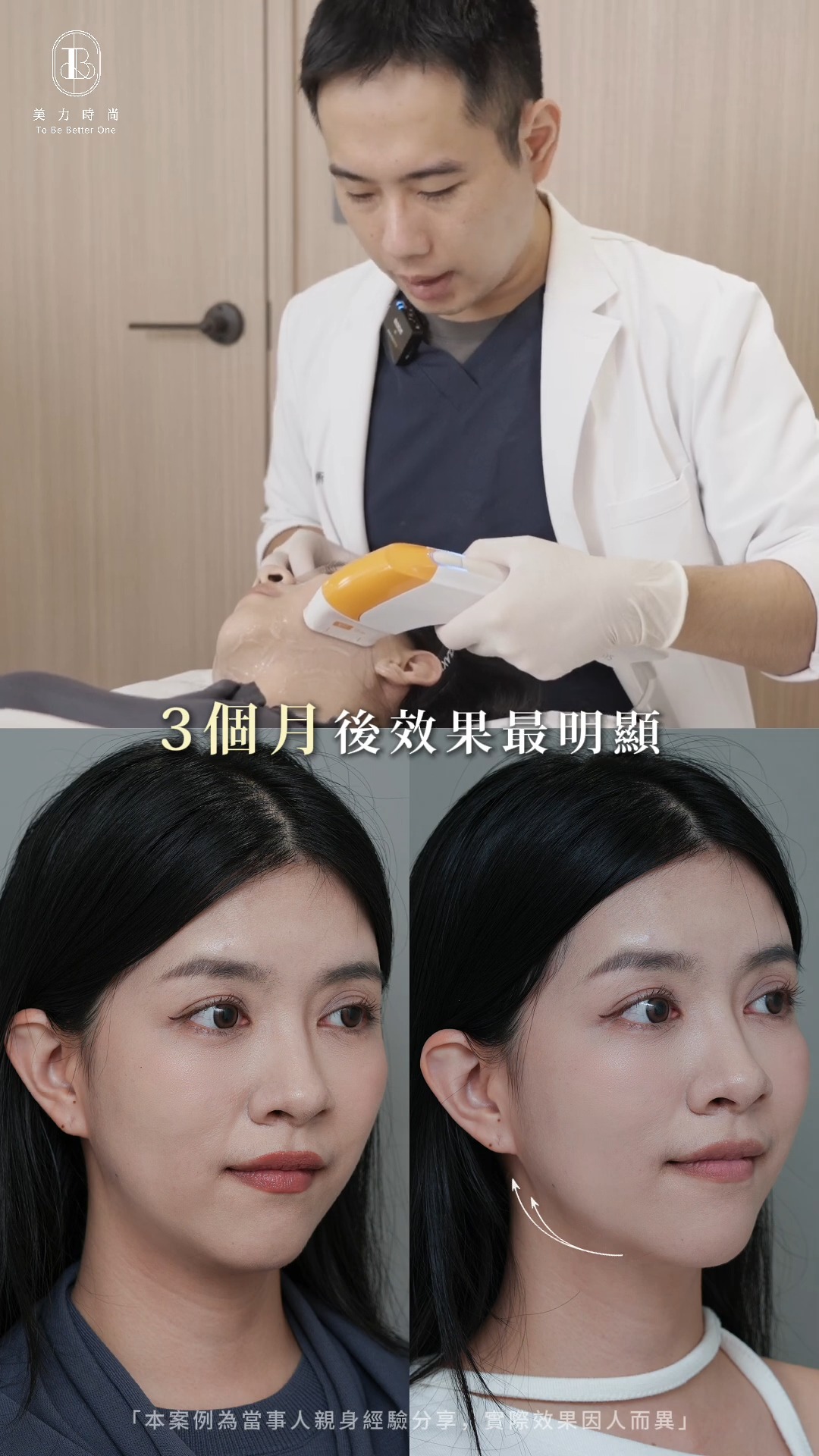 案例：陳璿宇醫師醫師施打海芙媚必提+小茜BA