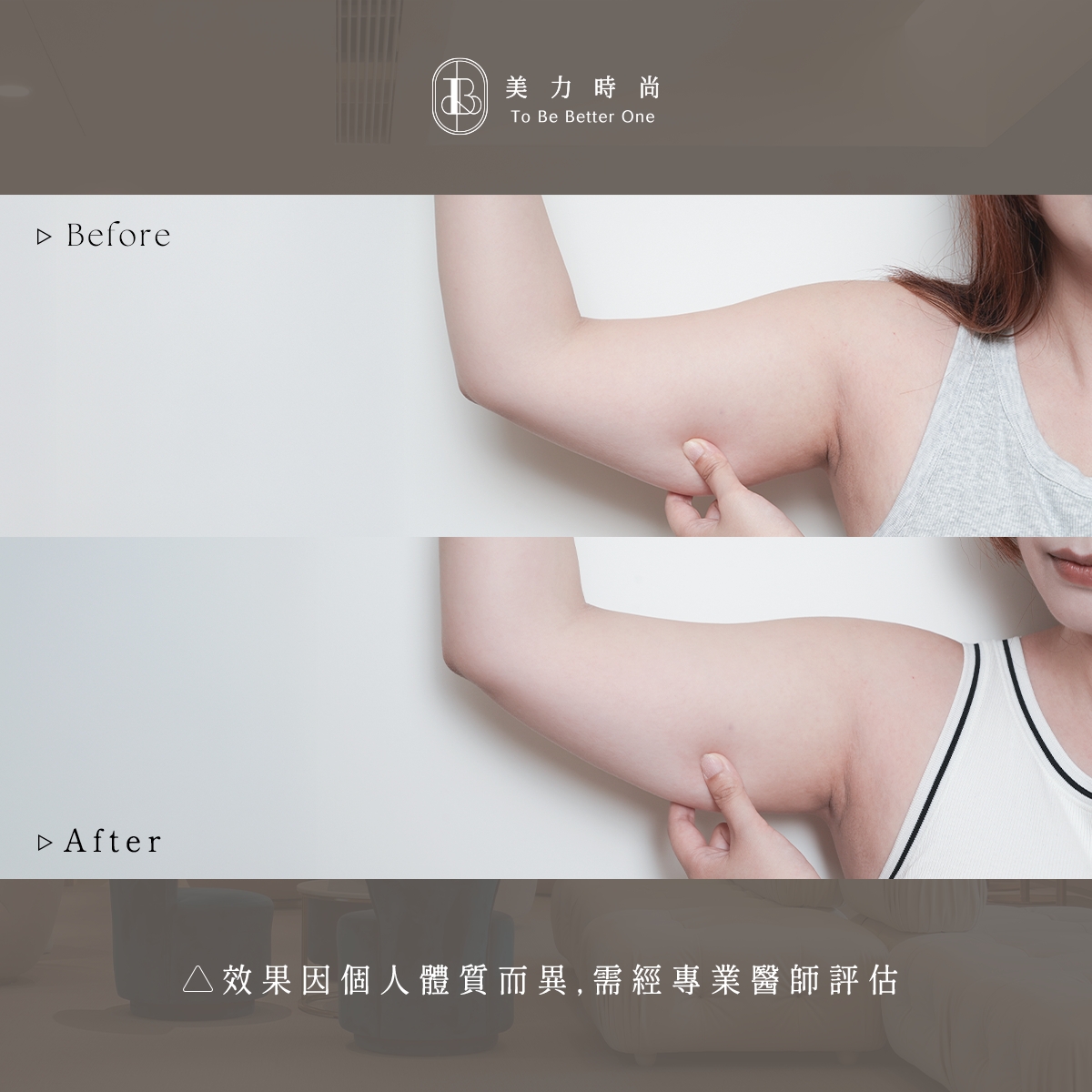 美力時尚診所冷凍減脂案例：阿爾發手臂BA