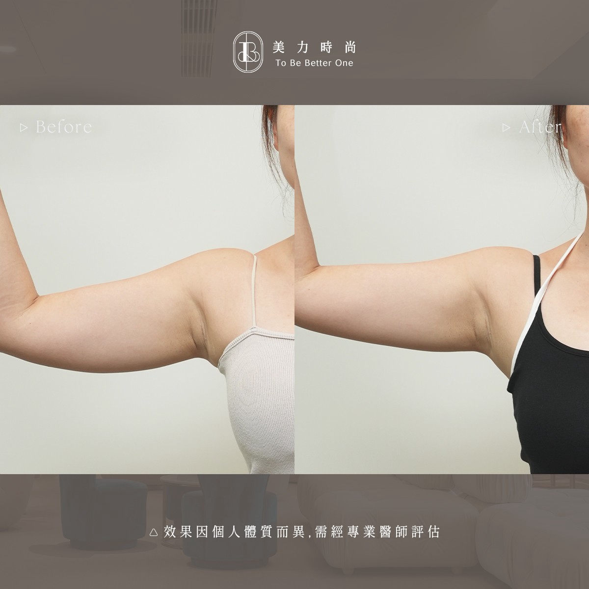 美力時尚診所冷凍減脂案例：阿爾發手臂BA