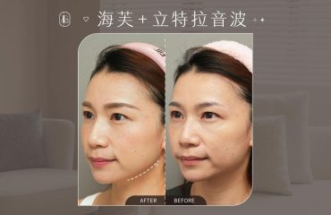 美力時尚診所案例：海芙音波+皇后音波BA