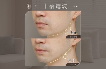 美力時尚診所案例：十蓓電波BA 男性俐落輪廓線