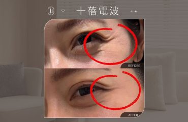 十蓓電波-潘森森BA 眼周紋路改善