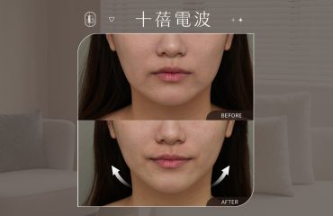 美力時尚診所案例：十蓓電波BA