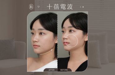 美力時尚診所案例：十蓓電波BA