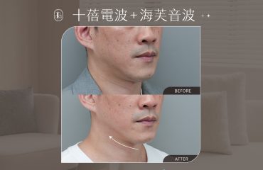 美力時尚診所案例：十蓓電波＋海芙音波BA