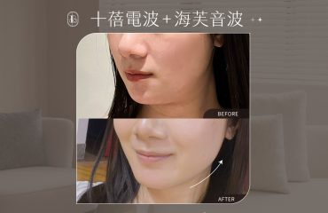 美力時尚診所案例：網紅《Krystal》體驗十蓓電波&海芙音BA