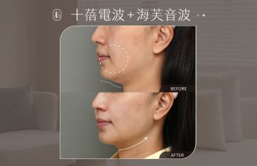 美力時尚診所十蓓電波＋海芙音波案例：雙下巴改善、輪廓線變清晰