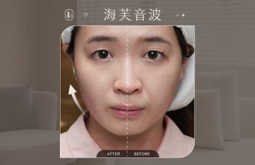 美力時尚診所海芙音波案例：Summer改善臉部鬆弛、嘴邊肉、雙下巴BA