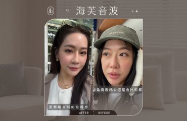 美力時尚診所案例：海芙音波-潘森森BA