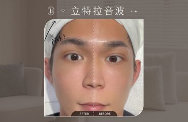 立特拉音波眼周拉提-勳狗