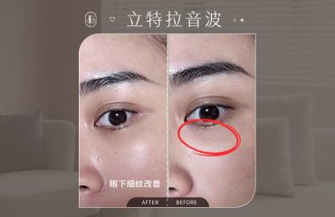 立特拉音波-安妮 眼周ba