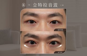 美力時尚診所案例：立特拉眼周音波BA