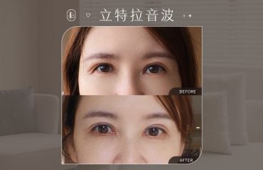 立特拉眼周音波