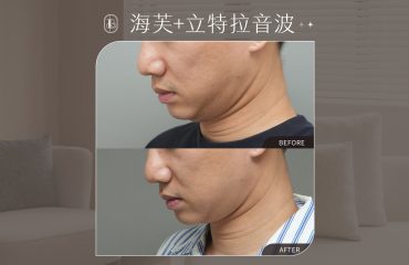 韓國音波雙機-王皓宇-封面圖-雙下巴改善有感